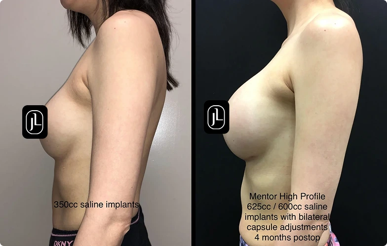 Before and After Gallery: Breast Fat Transfer