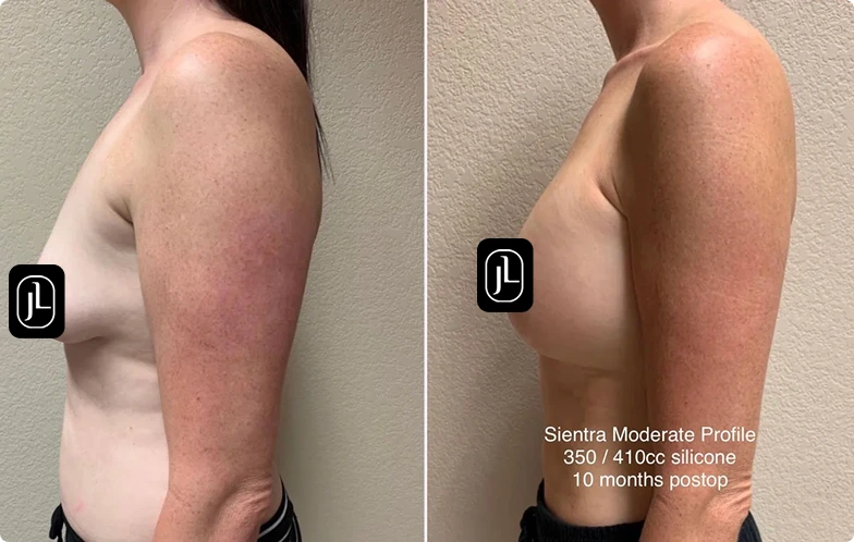 Before and After Gallery: Breast Fat Transfer