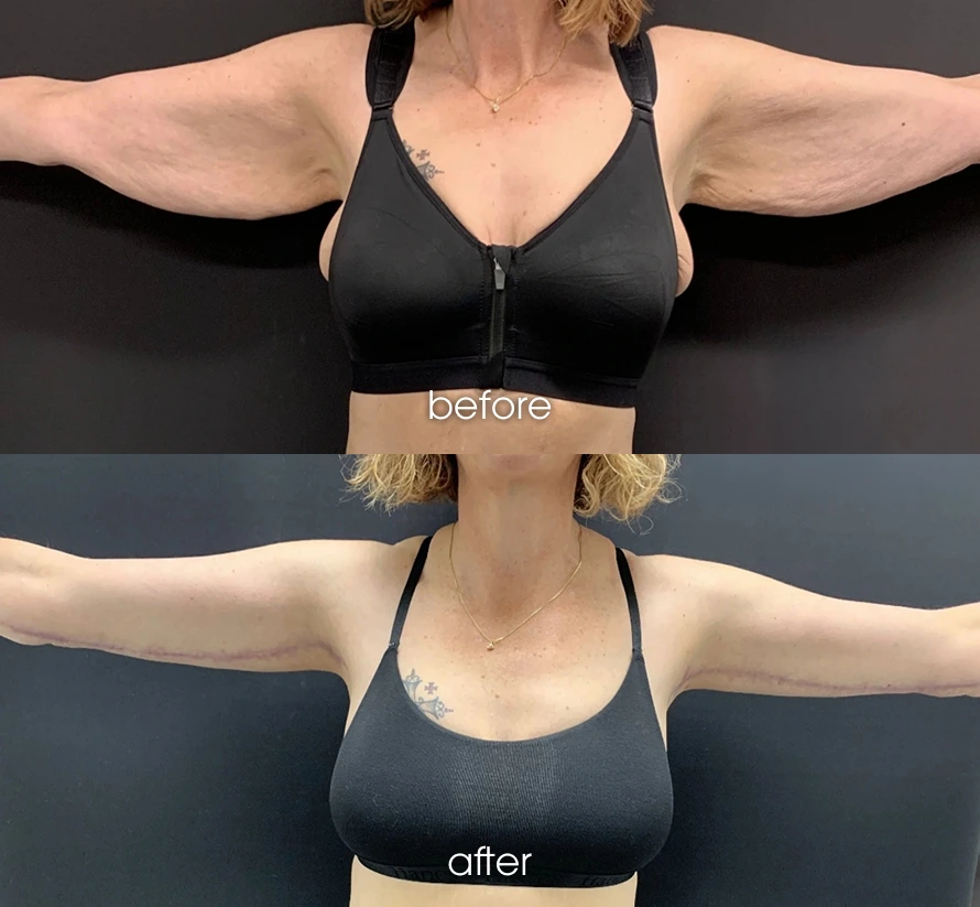 Arm Lift