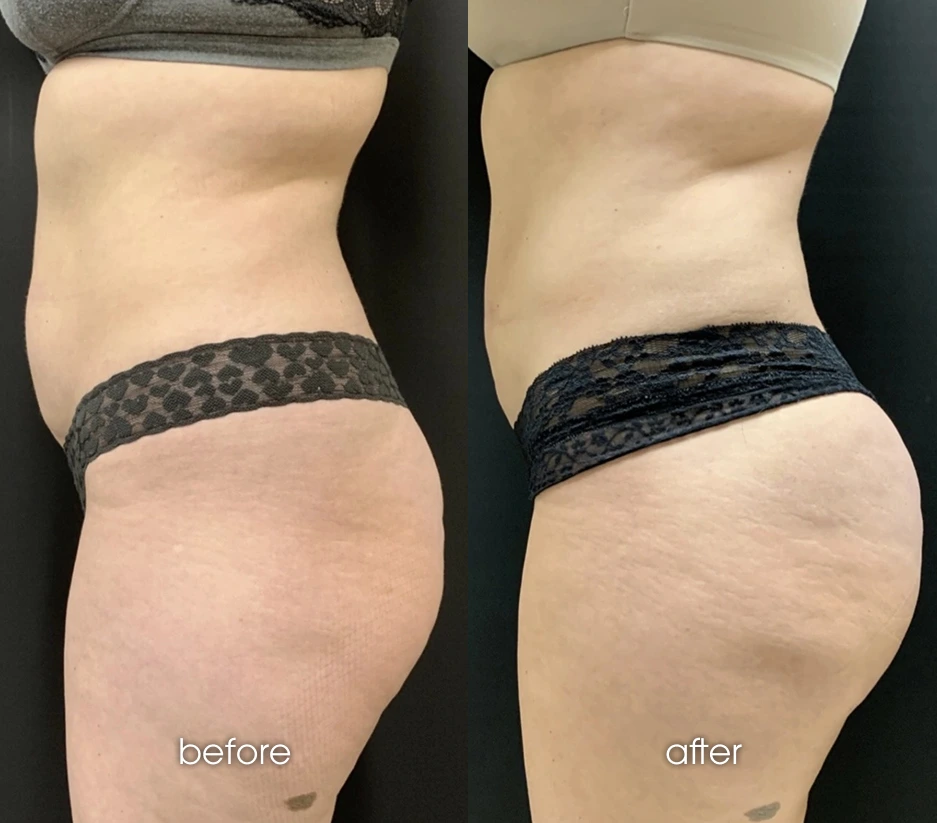 Brazilian Butt Lift