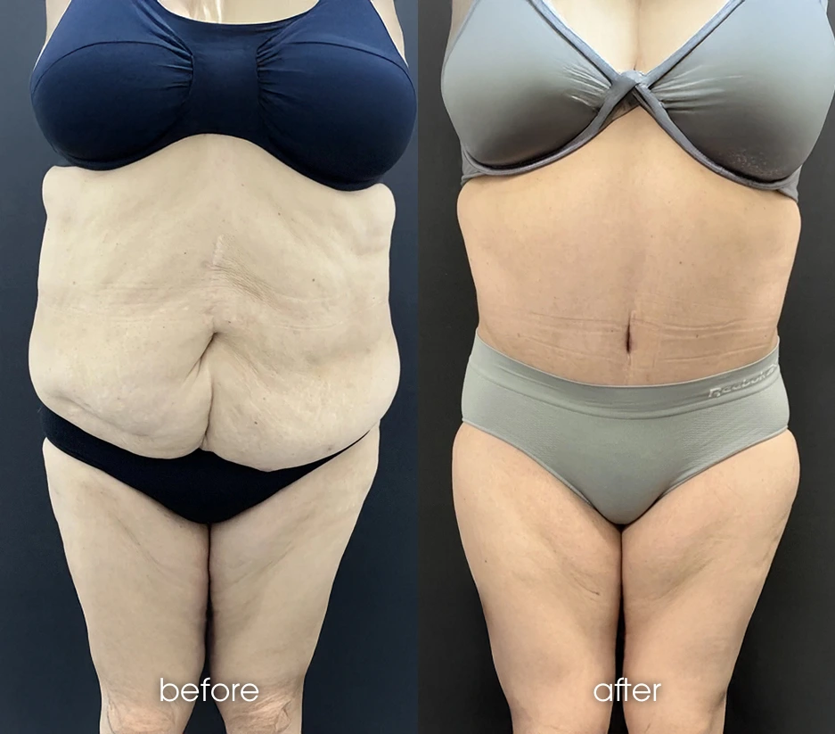 High-BMI Tummy Tuck