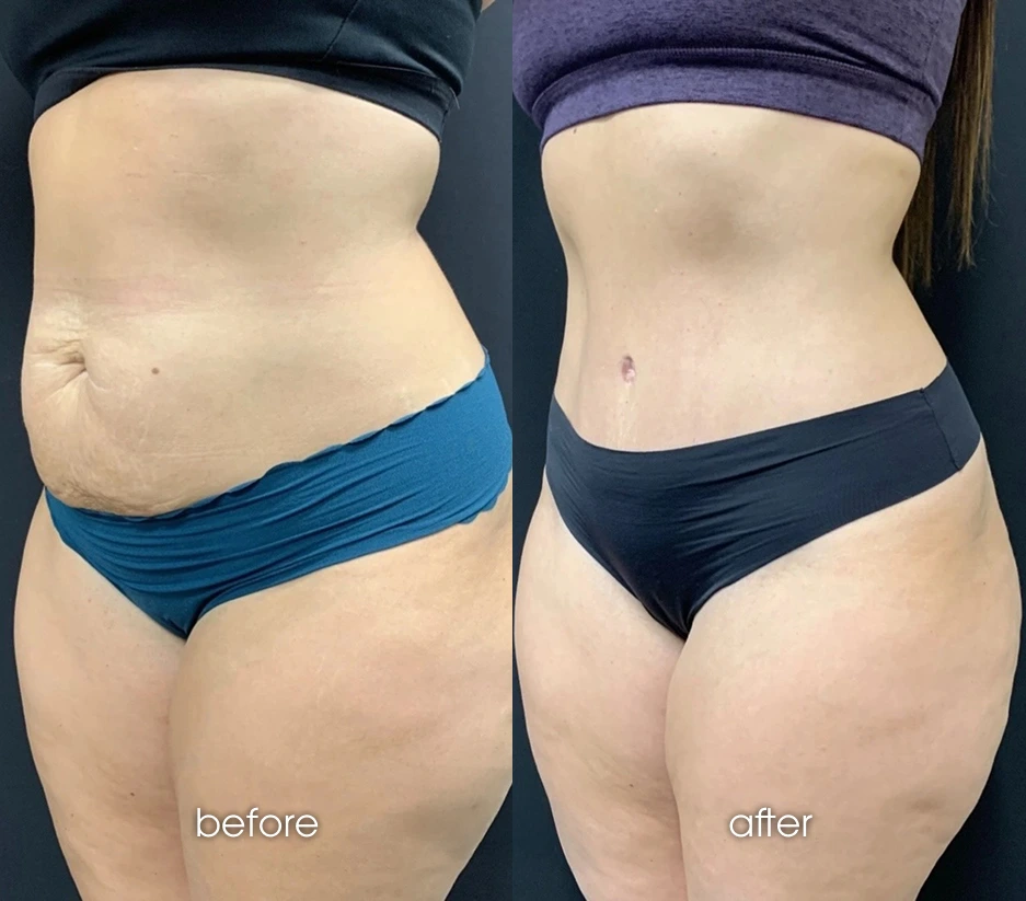 Liposuction