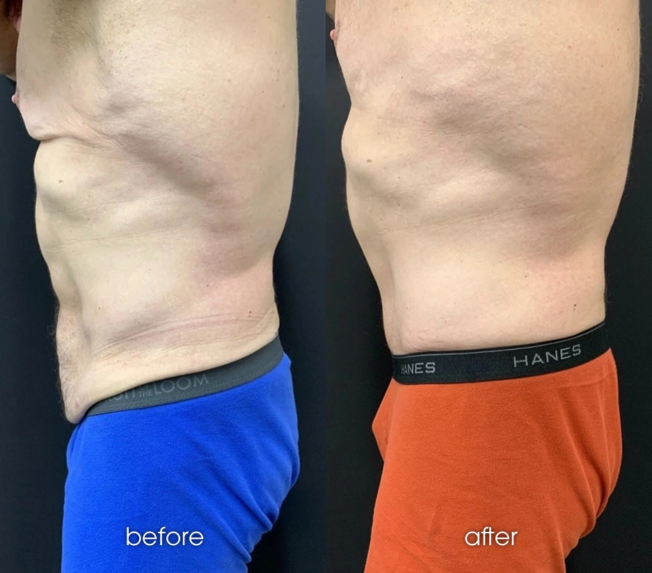 Male Tummy Tuck