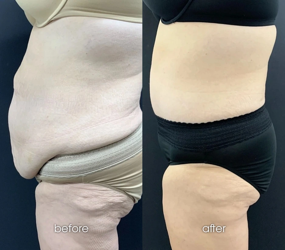 Tummy Tuck After Weight Loss