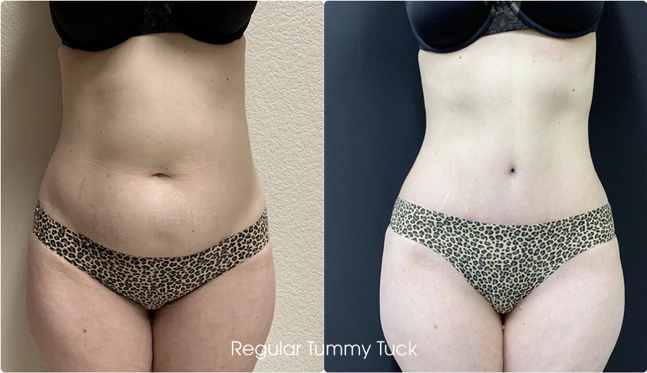 Regular Tummy Tuck Gallery: Before and After