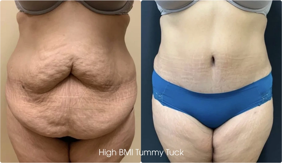 Regular Tummy Tuck Gallery: Before and After