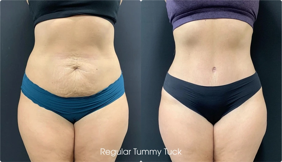 Regular Tummy Tuck Gallery: Before and After