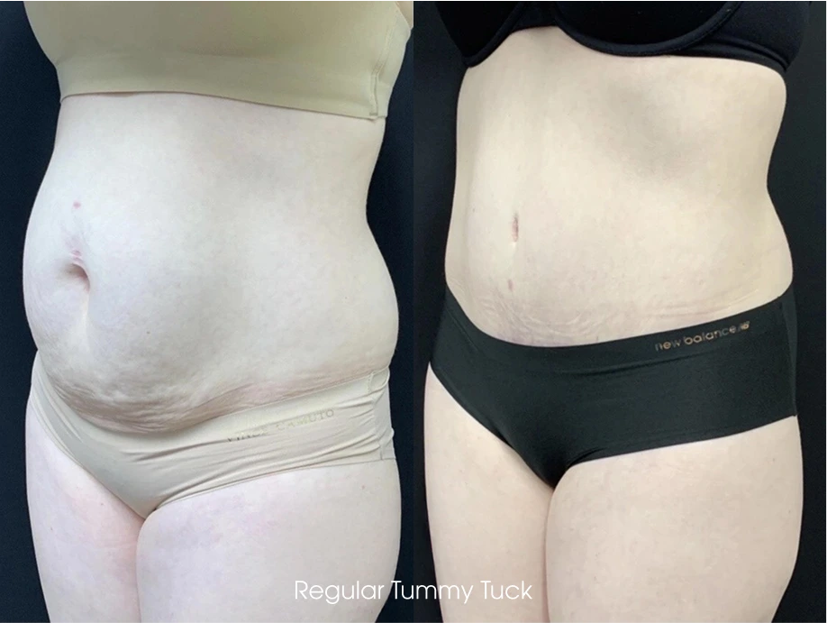 What Is a Tummy Tuck in Mesa Banner