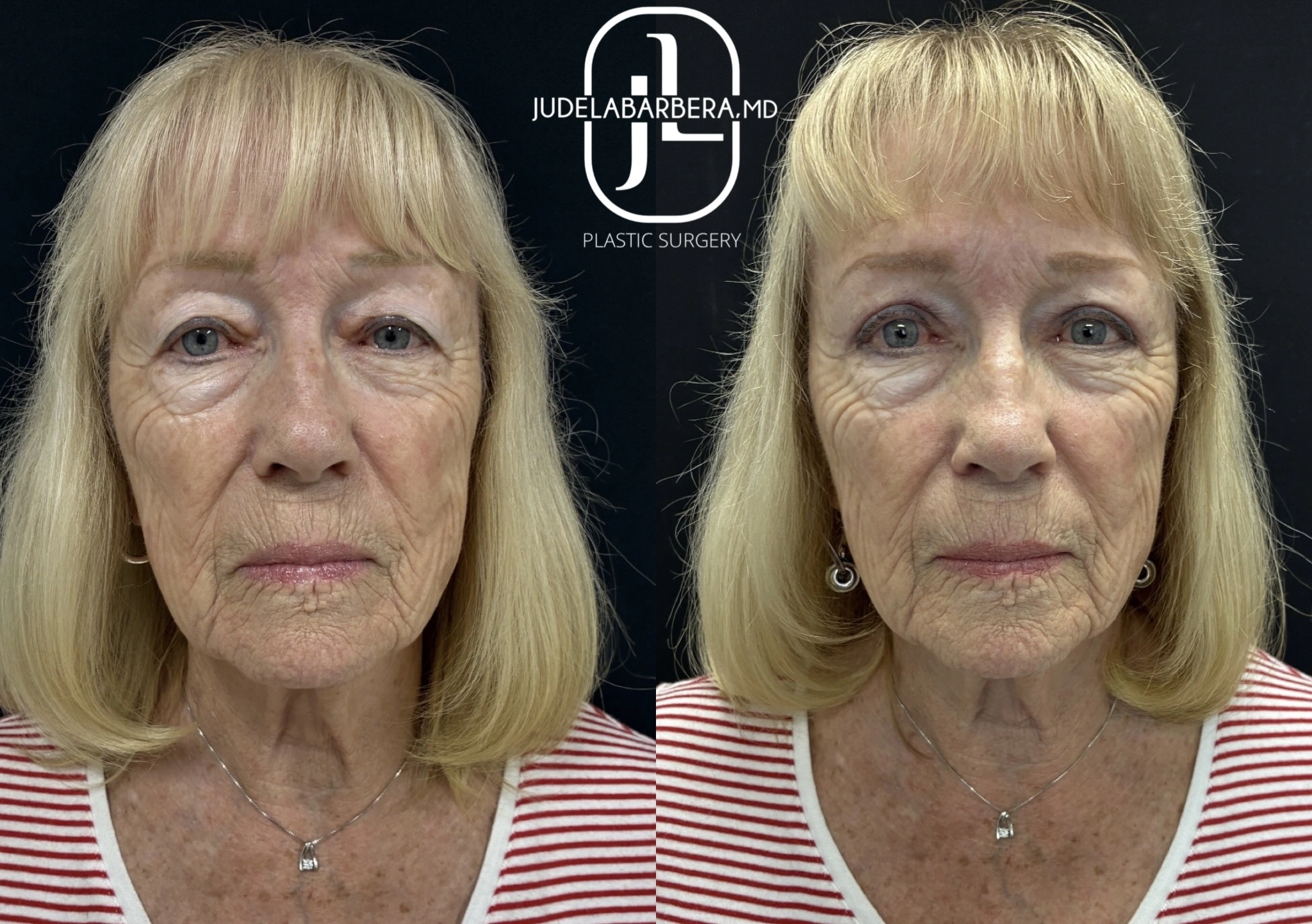 Before and After Gallery: Facelift Banner