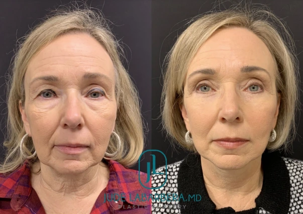 Before and After Gallery: Facelift Banner