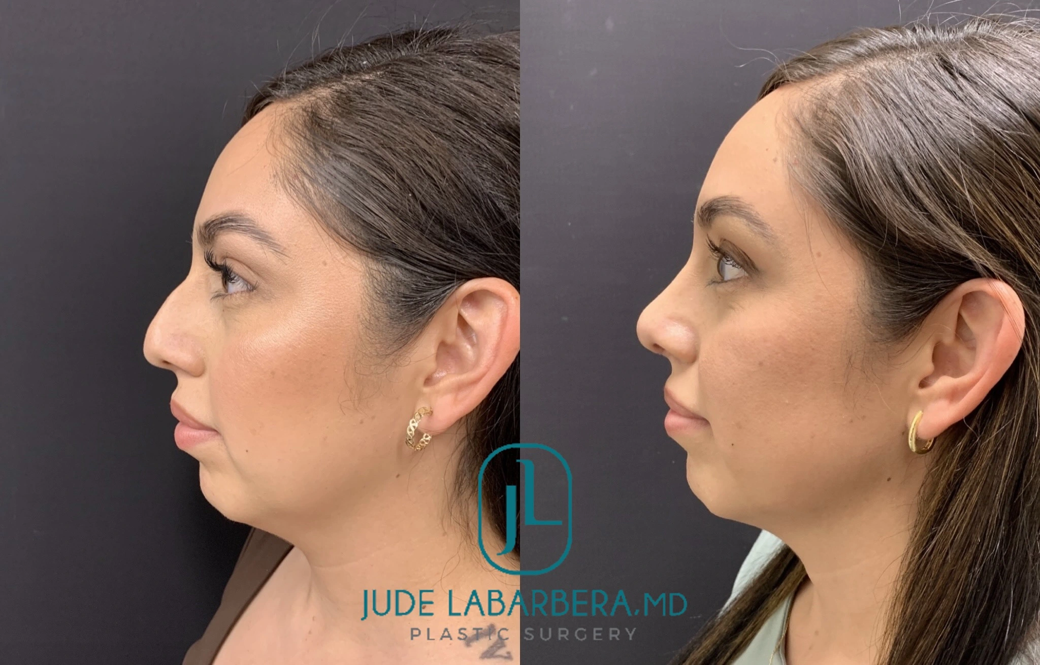 Before and After Gallery: Facelift Banner