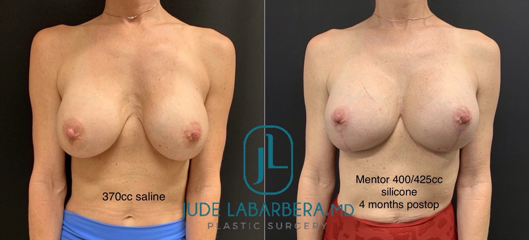 Before and After Gallery: Breast Augmentation Banner